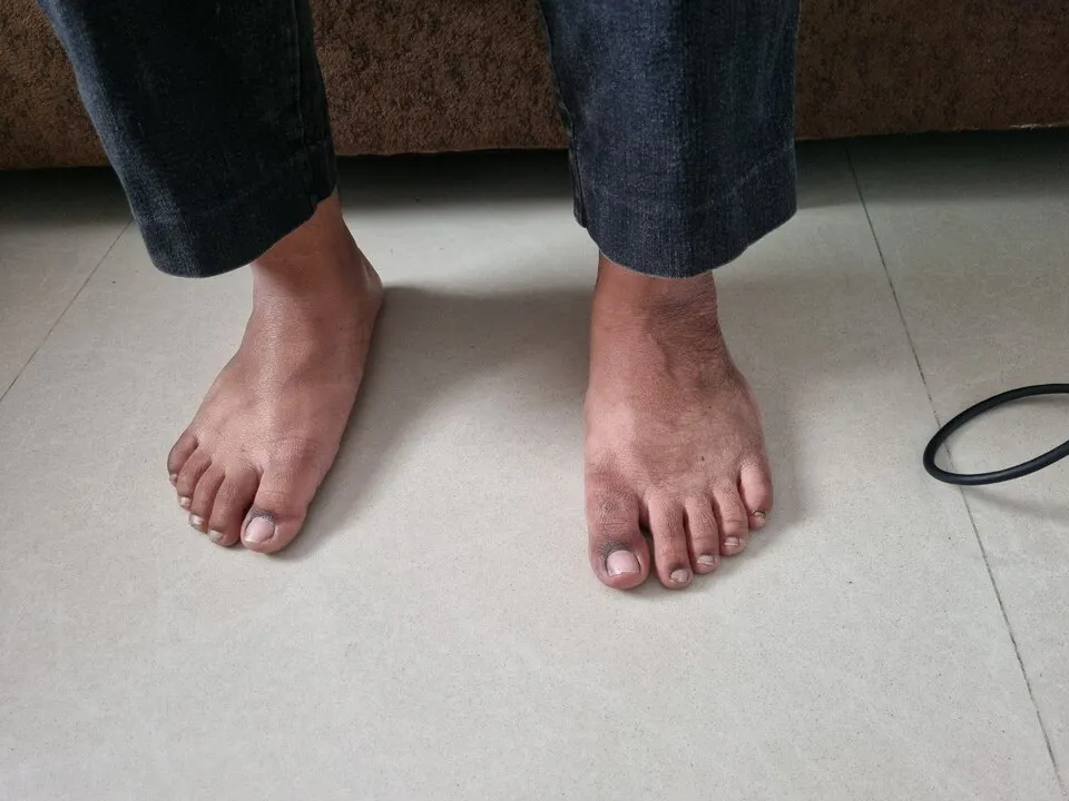 Flat foot (Pes planus)