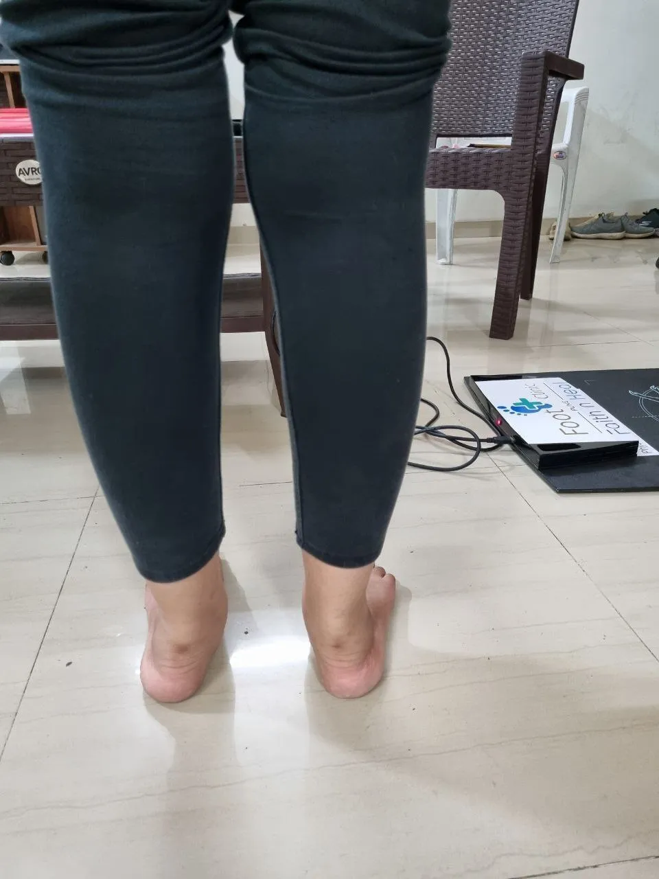 Foot overpronation