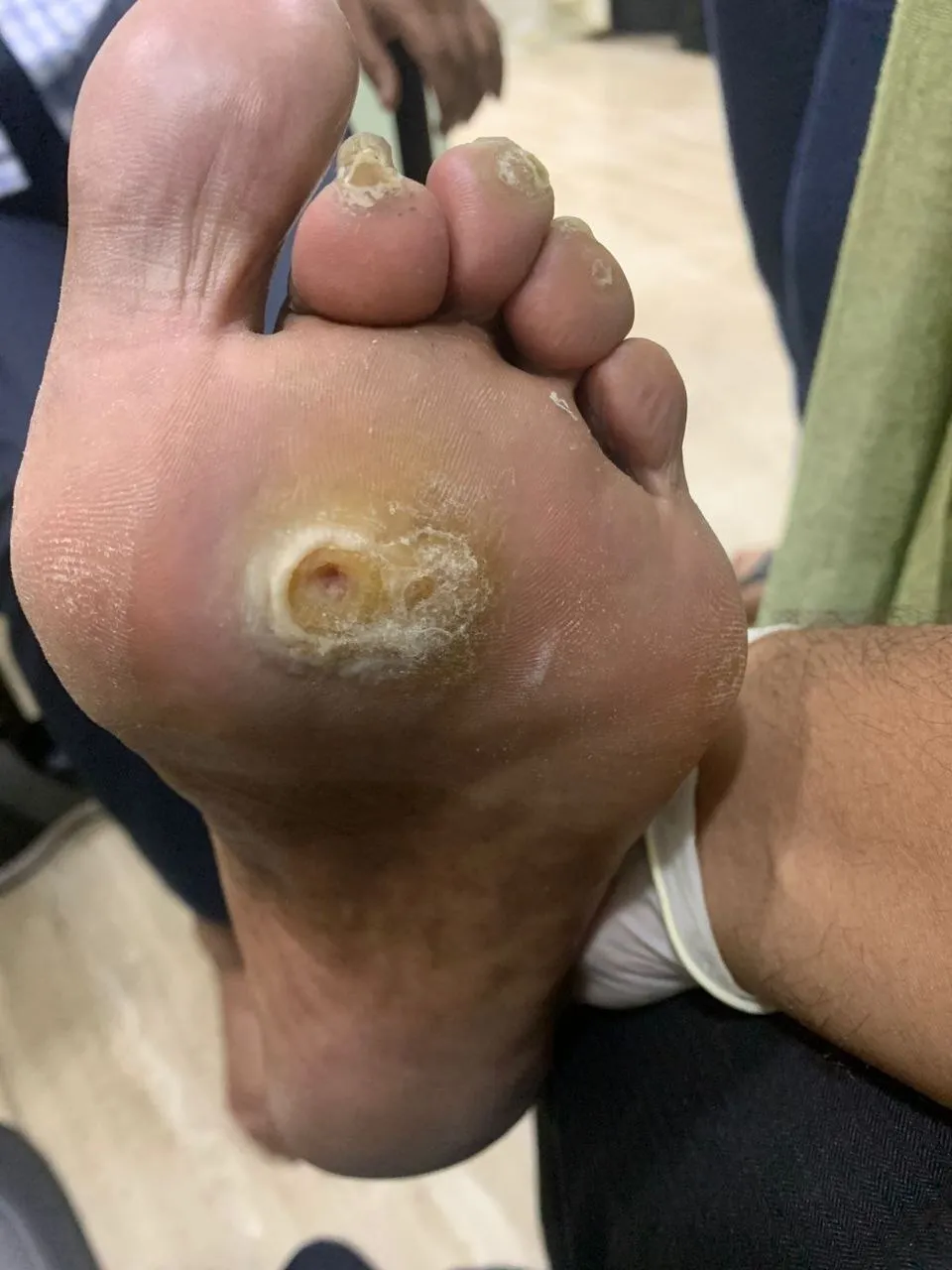 Recurring Corn & Callus
