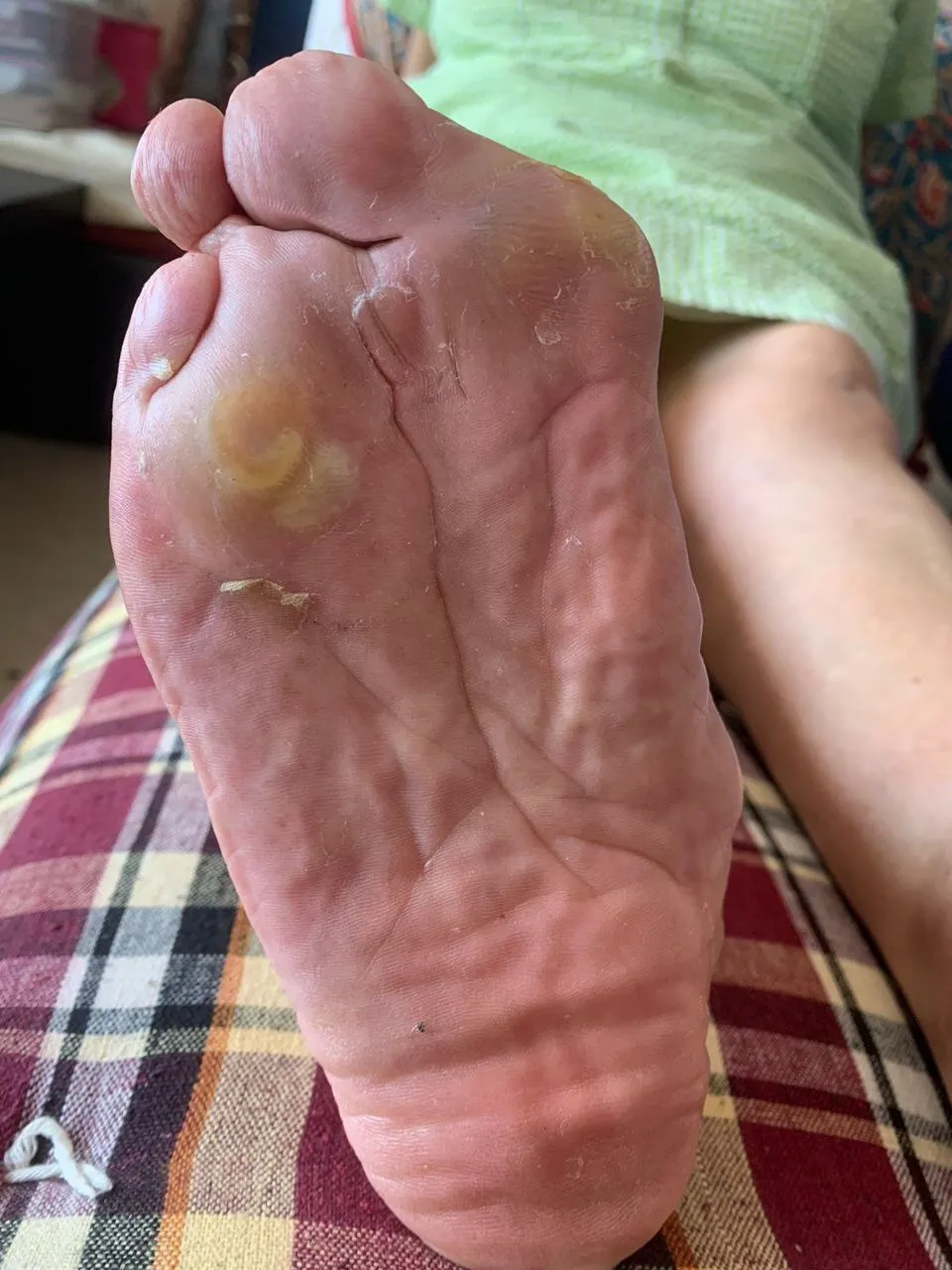 Toe bunions (Hallux valgus)