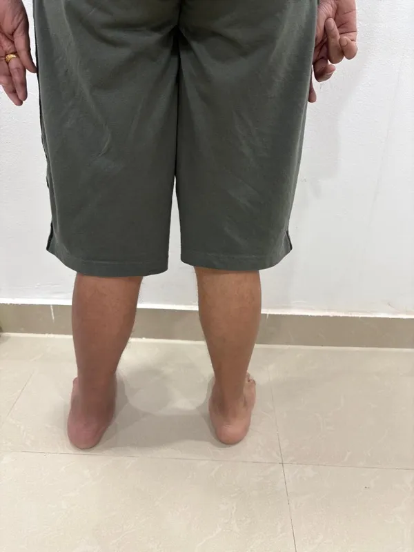 Treated Condition 44
