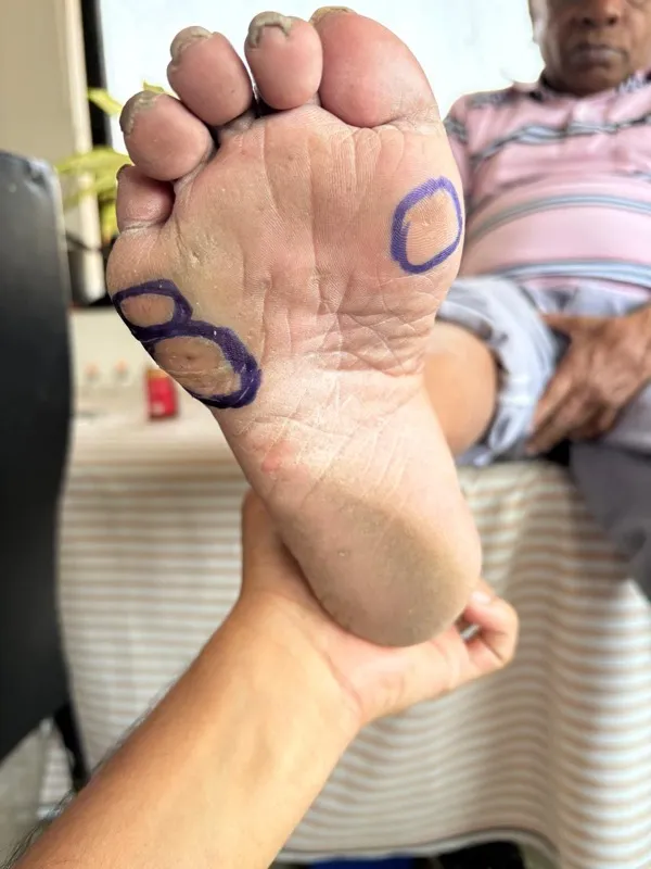Treated Condition 57